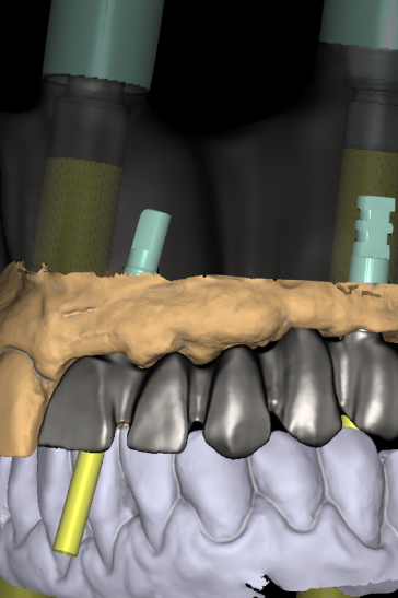 Tecnología digital en laboratorio dental