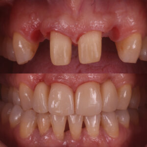 Antes y después de carillas dentales