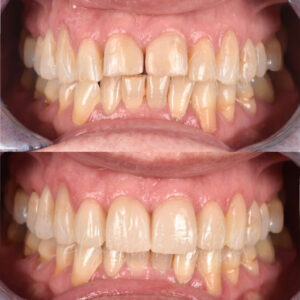 Proceso de diseño de sonrisa en clínica