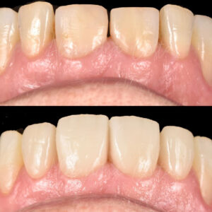 Antes y después de carillas dentales